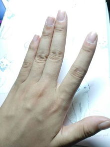 女,左手食指中指缝有痣 右手食指新长了颗红痣,有寓意吗 