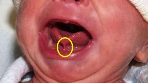 舌根臭怎么办有什么好的方法能够缓解这种症状