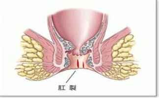 肛门出血是不是肛裂啊 无锡东方肛肠医院提醒