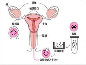 人工受孕成功几率到底有多高 