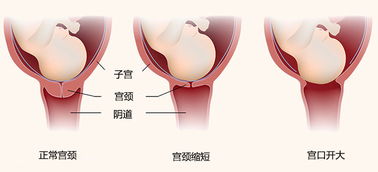 宫颈机能不全有什么症状(宫颈机能不全什么表现)