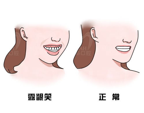 孩子牙不齐 龅牙需要换完牙才能做矫正吗