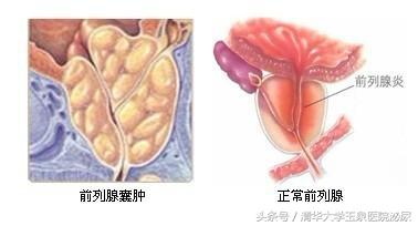 前列腺囊肿与年龄有关吗