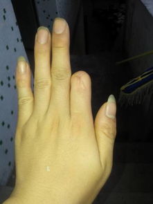 断了2个手指是几级残疾左手断食指右手断小指 