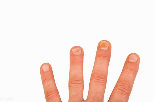 指甲瘪是什么原因造成的