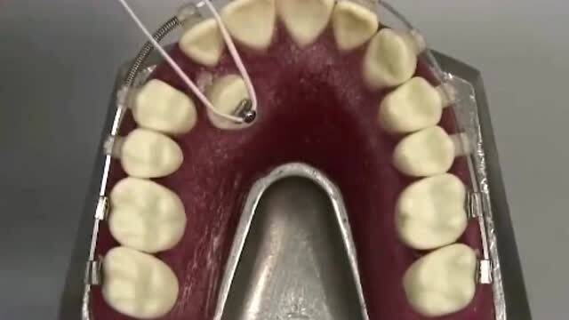 你是这样的牙齿类型吗,看看怎么矫正的,瞬间解惑不少 