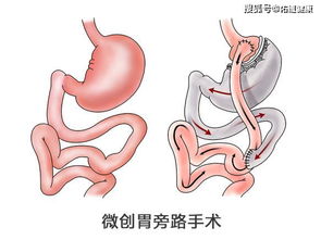 每个肥胖者都羡慕的易瘦体质,减重手术居然可以做到