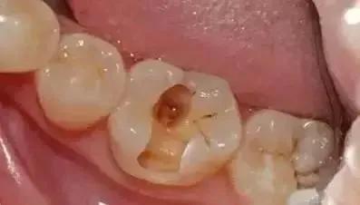 牙齿上的 黑线 是什么 是蛀牙吗