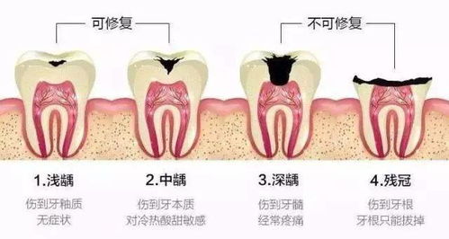 根管治疗后,医生建议你做冠的3个理由