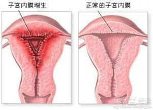 子宫内膜息肉的危害