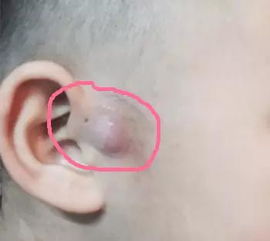 为什么宝宝耳朵旁边有个小洞 还会流脓,医生说要切除...