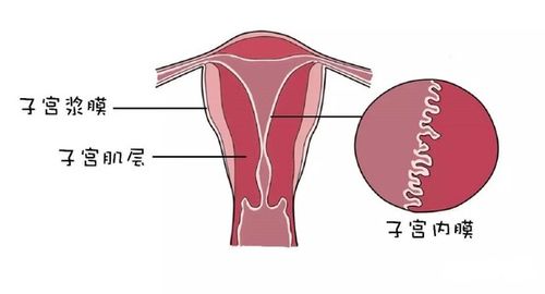 腺肌症可导致女性不孕 有这些症状的女性要小心