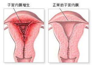 内膜如何快速增厚 子宫内膜怎么才能增厚