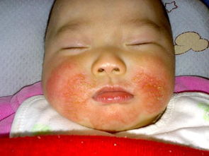 婴儿湿疹初期处理,婴儿湿疹的治疗方法?