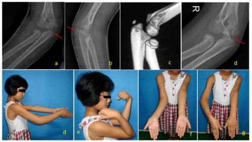 中国儿童骨科医生在国际骨科期刊发表儿童肘关节骨折新分型 转载自唯医网