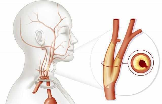 预防脑卒中 早做颈动脉超声检查