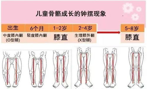 宝宝O型腿 X型腿 内八字 不矫正有什么后果