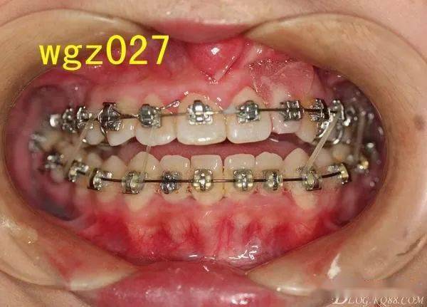 二手病例腭裂术后前牙开合矫治进展组图