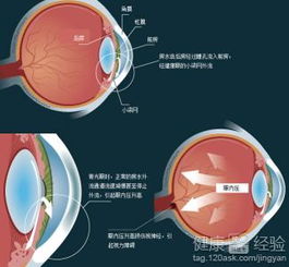 请问我有青光眼现在正在点眼药还..