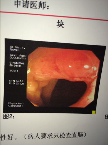 小肠胶囊内镜医保报销吗 胶囊肠镜医保