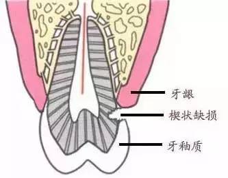 一直横着刷牙,会对牙齿造成多大的伤害