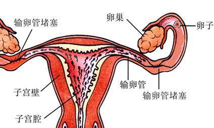 为什么输卵管阻塞会不孕？想尽快怀孕该到底该如何做？