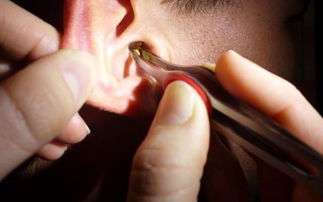 耳朵的耳屎很多到底要不要掏 医生告诉你处理耳屎的正确做法 