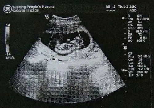 原创孕检时，B超单上若有这3种“情况”，或许会生下“男宝宝”