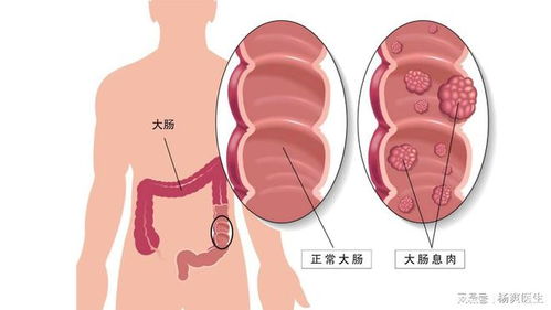 中医能治结肠息肉吗(中医能治结肠息肉吗能治好吗)