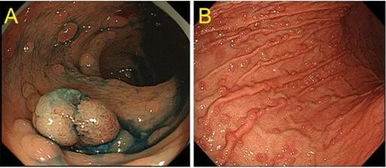 胃镜检查中常见的胃息肉病