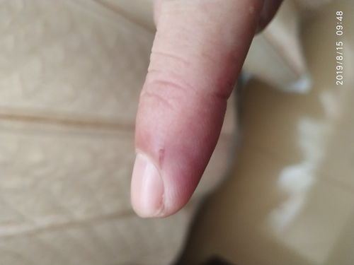 手指被乌龟咬破了要不要打狂犬疫苗呢 
