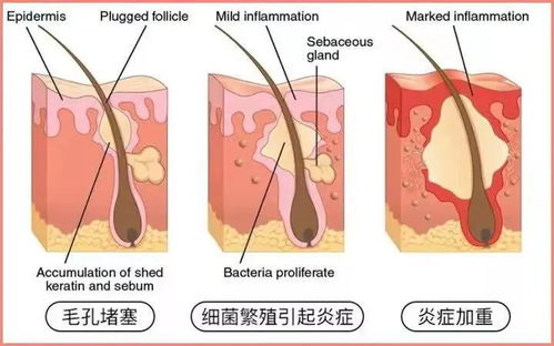 不是油痘肌建议刷酸吗