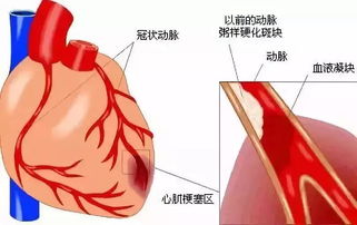 终年58岁 百亿企业董事长突然去世 这病近期高发,几分钟可夺命