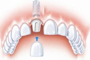 拔牙后可以马上种植 种植牙的过程