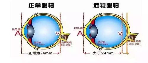 近视,能自愈吗