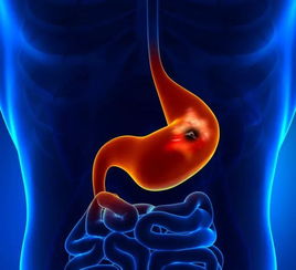慢性结肠炎易反复,不重视可致结肠癌 4个方法教你来应对