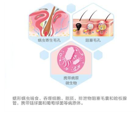 看爱尔儿童眼科医院眼科专家如何治疗干眼症