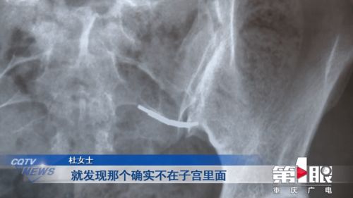 女子持续肚子痛 拍片一看惊呆了 安环一天就穿孔