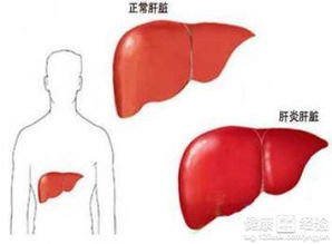 肝癌并发症肝癌破裂严重吗