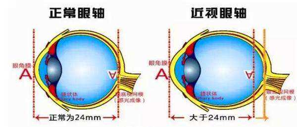 当孩子说 看不清黑板 了,说明已经近视了