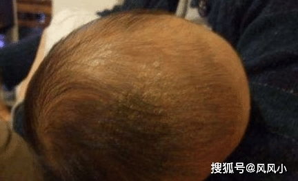 头皮不干净怎么弄好看？新生儿头皮垢如何清理需要注意什么(新生儿头皮屑怎么洗)