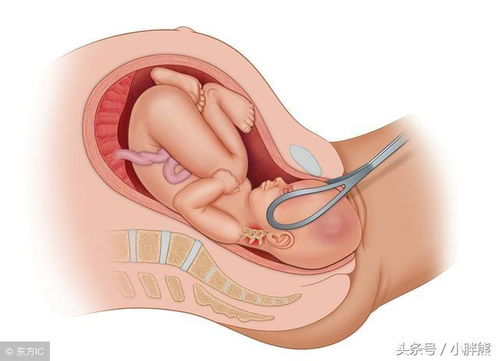 胎儿脐带绕颈了怎么办 