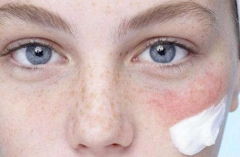 了解眼部皮肤过敏的原因是什么有利于对疾病斩草除根