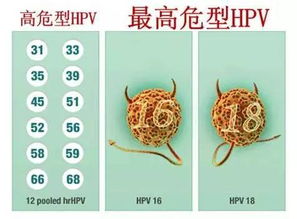 hpv16病毒的治疗方法有哪些？