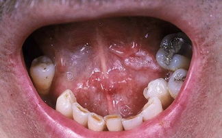 舌癌初期肉芽图片 