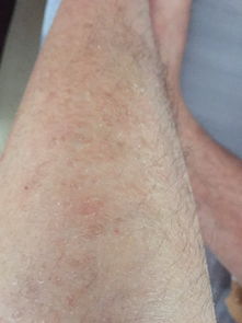 求医生看看我的腿部起皮有黑斑咋回事 
