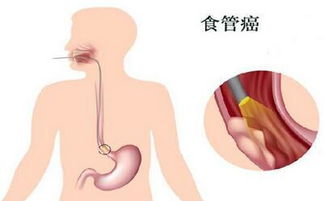 食道癌术后有哪些并发症 术后如何调理可恢复好 