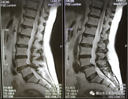 提示腰椎管狭窄的2大典型症状,你肯定忽视过