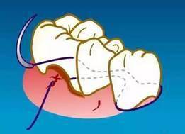 这些牙周缝合方法,99 的牙医都要知道 多图慎入