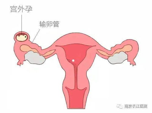 宫外孕切除左侧输卵管,如今备孕又遇右侧输阻 多囊